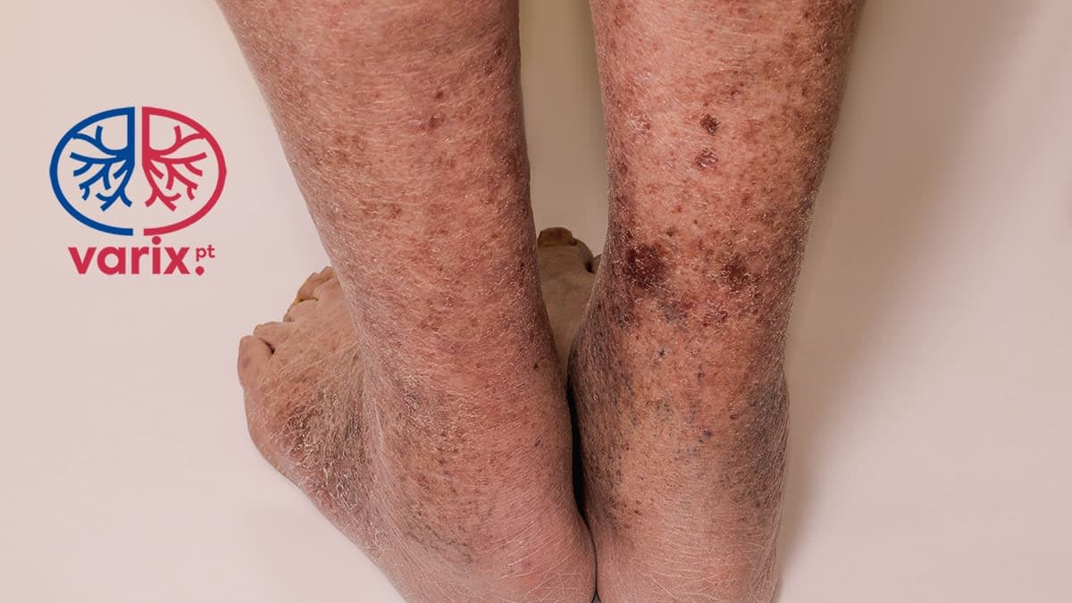 Dermatite Estase Venosa